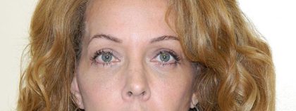 Blepharoplasty Before & After Patient #3093