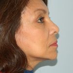 Mini Facelift Before & After Patient #2720