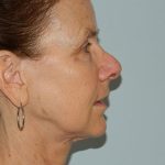 Mini Facelift Before & After Patient #2719