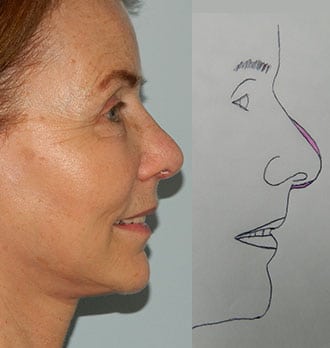 Mini Facelift Before & After Patient #2719