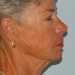 Mini Facelift Before & After Patient #2718
