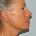 Mini Facelift Before & After Patient #2718