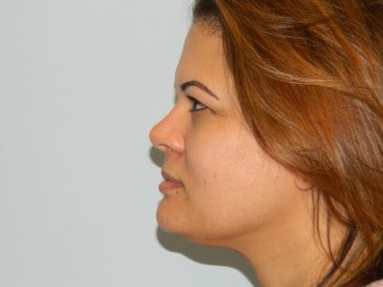 Injectable Fillers Before & After Patient #3279