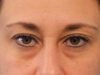 Blepharoplasty Before & After Patient #3157