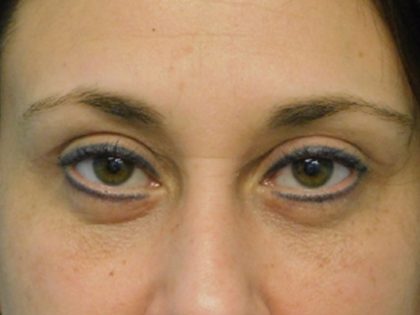 Blepharoplasty Before & After Patient #3157