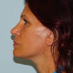Mini Facelift Before & After Patient #2995