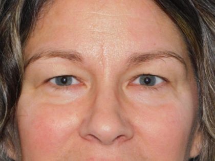 Blepharoplasty Before & After Patient #3159