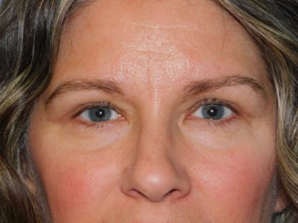Blepharoplasty Before & After Patient #3159