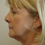 Traditional Facelift Before & After Patient #1689