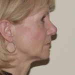 Traditional Facelift Before & After Patient #1717