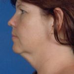 Traditional Facelift Before & After Patient #1718