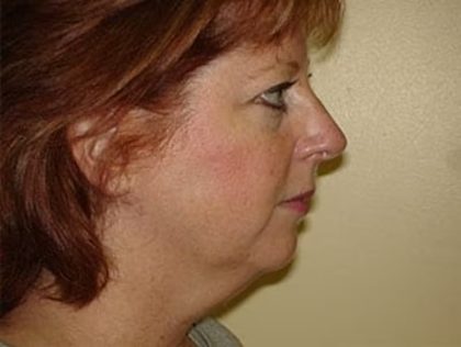 Traditional Facelift Before & After Patient #1720