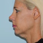 Traditional Facelift Before & After Patient #1810