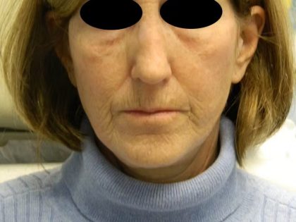 Fraxel Laser Resurfacing Before & After Patient #1492