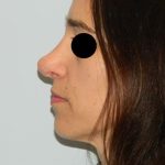 Revision Rhinoplasty Before & After Patient #1597