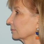 Revision Rhinoplasty Before & After Patient #1598