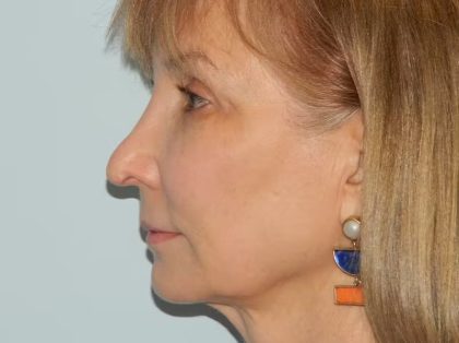Revision Rhinoplasty Before & After Patient #1598