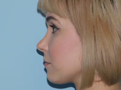 Revision Rhinoplasty Before & After Patient #1599