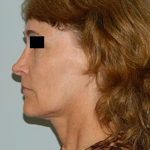 Revision Rhinoplasty Before & After Patient #1516