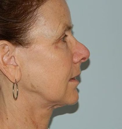 Revision Rhinoplasty Before & After Patient #1519