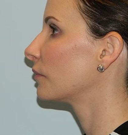 Revision Rhinoplasty Before & After Patient #1545