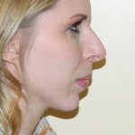 Revision Rhinoplasty Before & After Patient #1546