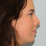 Chin Augmentation Before & After Patient #1038