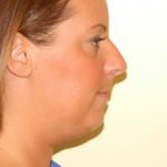 Chin Augmentation Before & After Patient #1119