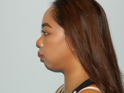 Chin Augmentation Before & After Patient #1206