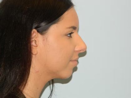 Chin Augmentation Before & After Patient #1207