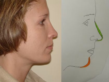 Chin Augmentation Before & After Patient #1083