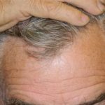 Hair Transplant Smartgraft Before & After Patient #1366