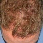 Hair Transplant Smartgraft Before & After Patient #1375