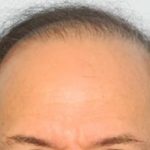 Hair Transplant Smartgraft Before & After Patient #1390