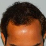 Hair Transplant Smartgraft Before & After Patient #1348