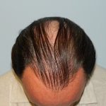 Hair Transplant Smartgraft Before & After Patient #1399