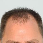 Hair Transplant Smartgraft Before & After Patient #1400