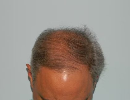 Hair Transplant Smartgraft Before & After Patient #1401