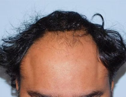 Hair Transplant Smartgraft Before & After Patient #1402