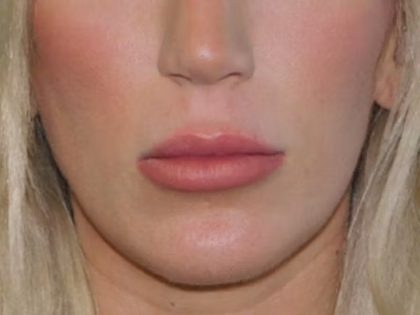 Lip Lift Before & After Patient #1287