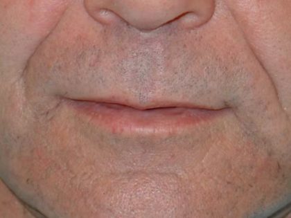 Lip Lift Before & After Patient #1288