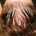 PRP Injections for Hairloss Before & After Patient #1476