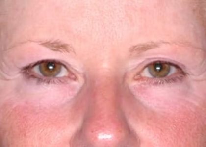 Ultherapy Before & After Patient #1437