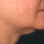 Ultherapy Before & After Patient #1449