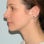 Rhinoplasty Before & After Patient #2679