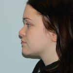 Rhinoplasty Before & After Patient #2708