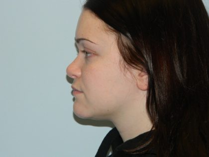 Rhinoplasty Before & After Patient #2708
