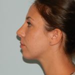 Rhinoplasty Before & After Patient #2710