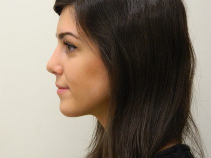 Rhinoplasty Before & After Patient #2712
