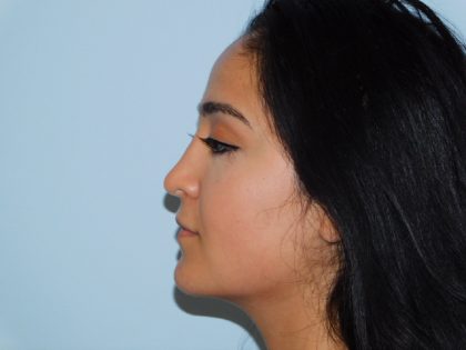Rhinoplasty Before & After Patient #2939